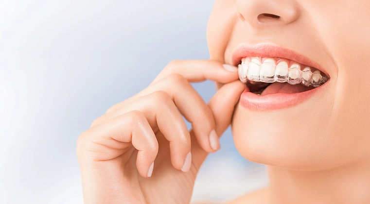 Элайнеры 3D Smile
